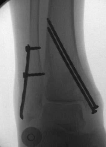 Fibular comminution Common in SER, PER and PAd fracture patterns Pronation-Adduction Fx Critically review injury XR Operative plan: - Can t always lag