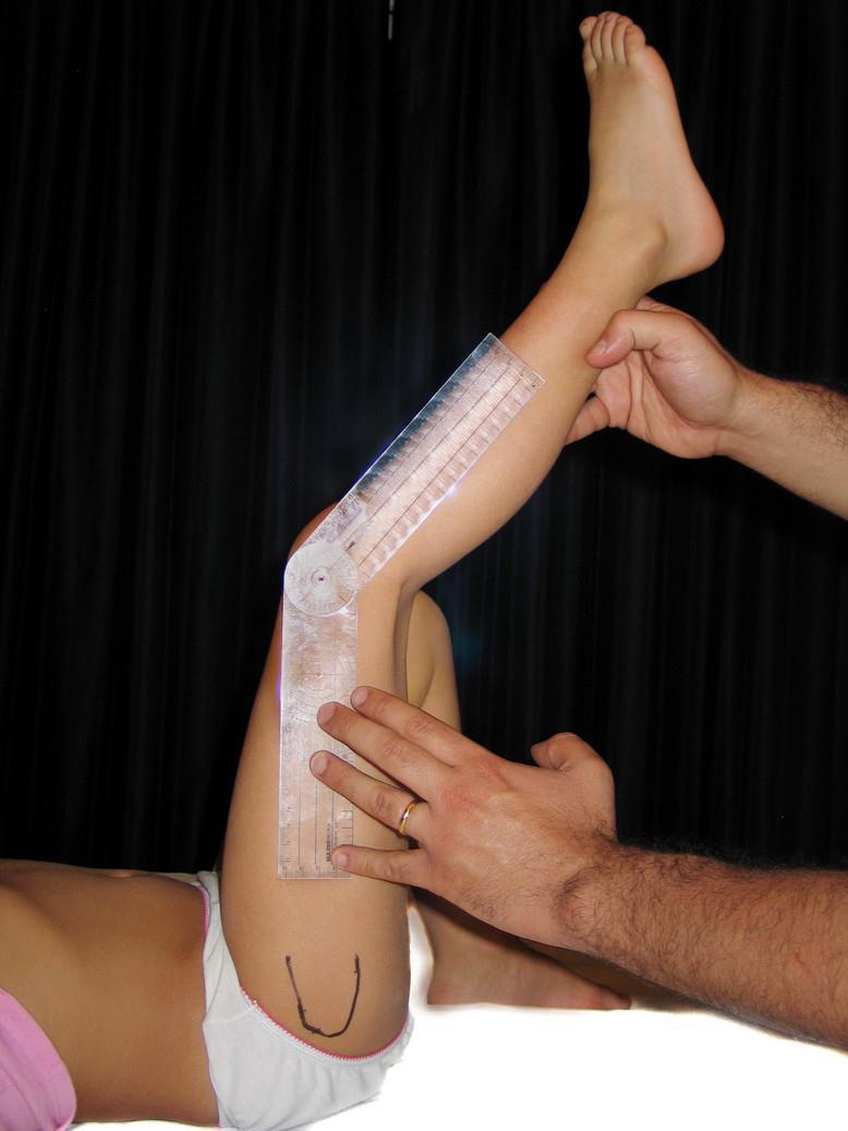 Physical examination Knee flexion deformity predominates Popliteal