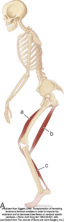 III-IV Severe knee flexion in