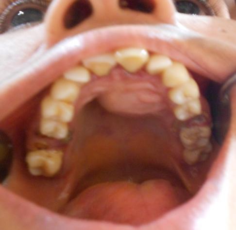 Figure 1: Swelling on the palatal rugae area Figure 2: Well-defined unilocular radiolucency associated with maxillary right and left incisors and canine with sclerotic margin The pathogenesis of