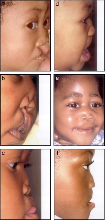 Fig. 5. (a f) Three patients with pre-operative and post-operative appearances of midface and nose after creation of columella and closure of median cleft lip.