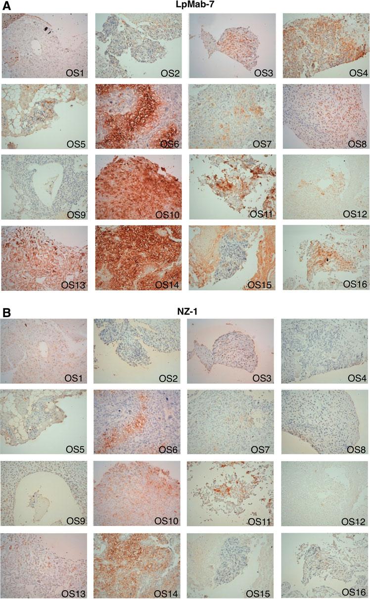 156 KANEKO ET AL. FIG. 1. Immunohistochemical analysis by LpMab-7 and NZ-1 against osteosarcoma tissues.