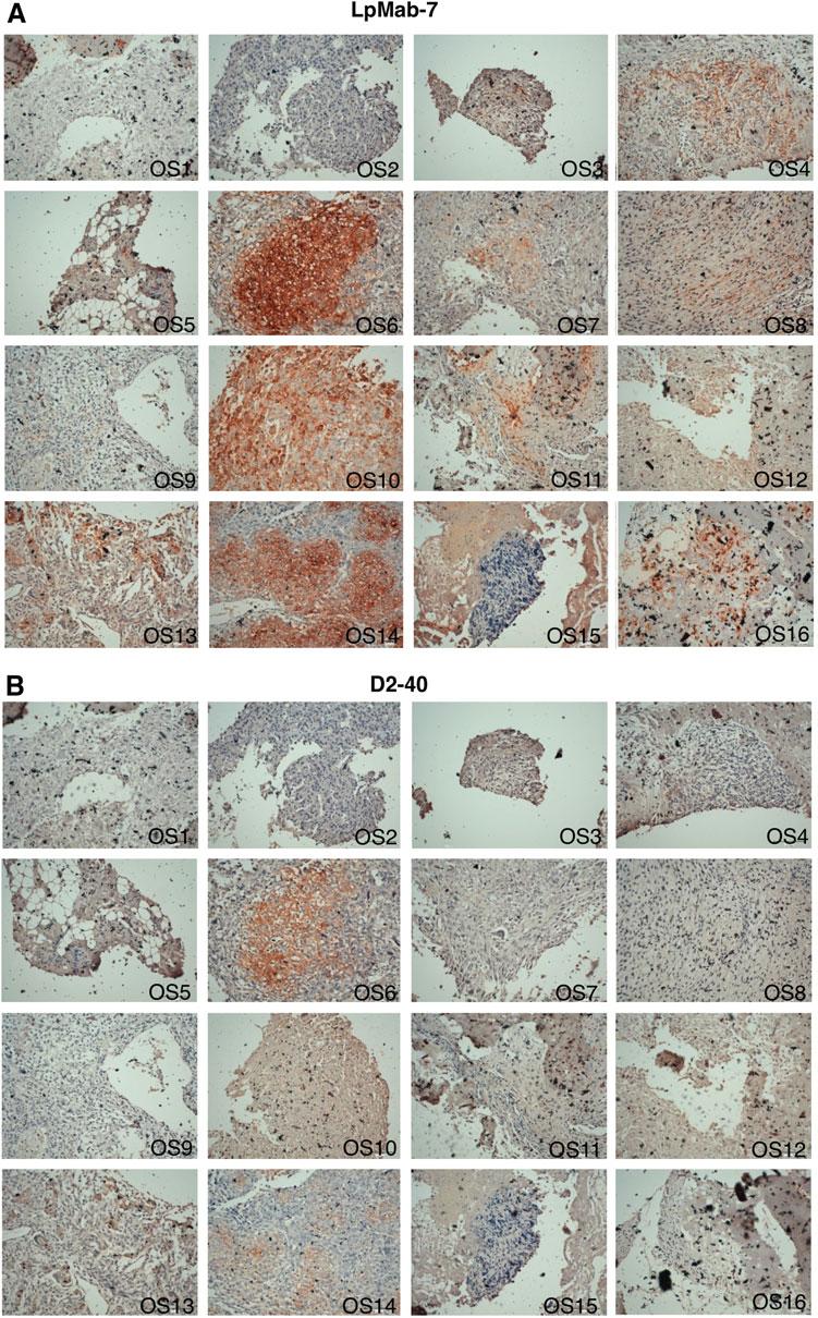 LpMab-7 DETECTS PODOPLANIN OF METASTATIC OSTEOSARCOMA 157 FIG. 2. Immunohistochemical analysis by LpMab-7 and D2-40 against osteosarcoma tissues.