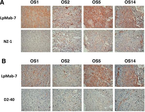 LpMab-7 DETECTS PODOPLANIN OF METASTATIC OSTEOSARCOMA 159 FIG. 4. Immunohistochemical analysis against metastatic osteosarcomas using three anti-podoplanin MAbs.