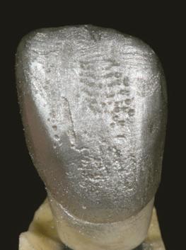 The cut-back was designed to mimic the internal mamelon forms while maintaining the palatal aspect of the crown. The matrix served as a guide in achieving accurate reduction.