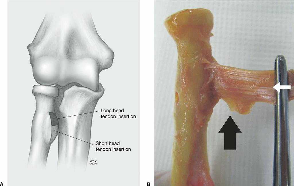 Athwal, Steinmann, and Rispoli / Distal Biceps Tendon Anatomy 1227 Figure 2. The long- and short-head biceps tendon insertions are illustrated (A).