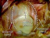 Superior Glenohumeral Ligament Middle Glenohumeral Ligament