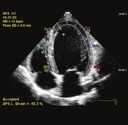 Measurement of strain acmq A.I. provides for the measurement of strain within a segmented Region of Interest (ROI). Previously Philips used a 7-segment ROI for each left ventricle (LV) apical view.
