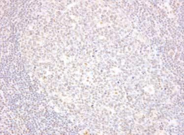 302 pressive properties of TGF- and so enhances cell proliferation, and this may be an important step in the development of malignant lymphoma.