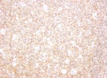 Expression of Smad in Lymphomas 303 A B Fig. 2.