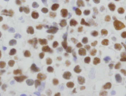 Aggressive lymphomas with MYC genetic and protein alterations MYC ALK+ Large Cell