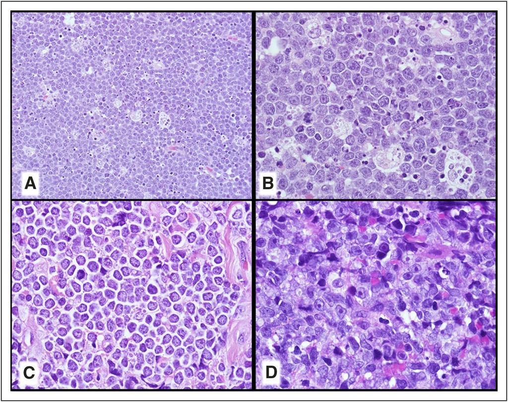 Cytologic spectrum of HGBL, with MYC and BCL2 and/or BCL6 rearrangements