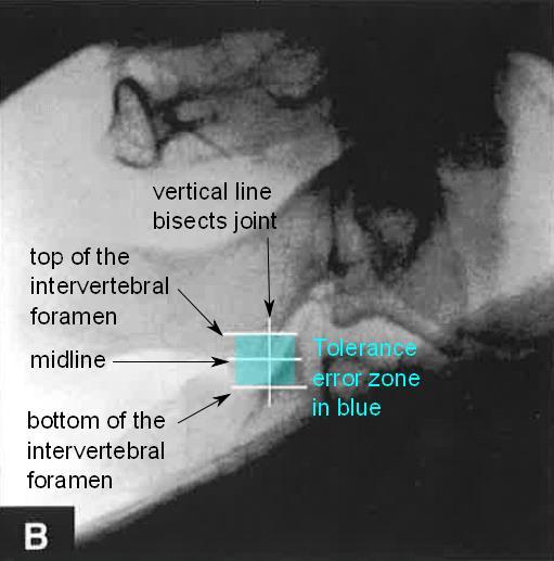 TON Block Tolerable error zone is a rectangular area bounded by the anterior edge of the C3 SAP, upper and lower lines perpendicular passing posteriorly from the apex of the SAP and from the bottom