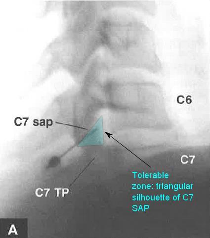 C7 Medial Branch Tolerable insertion zone should be no greater than the triangular silhouette of the C7 SAP Place needle at apex of C7 SAP Confirm placement with AP view.