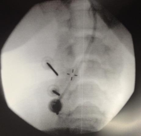 Posterior Approach Cervical Medial Branch Patient prone position Placement of a marker needle Obtain lateral view, identify the center of the neural arch at the target level Insert marker needle and