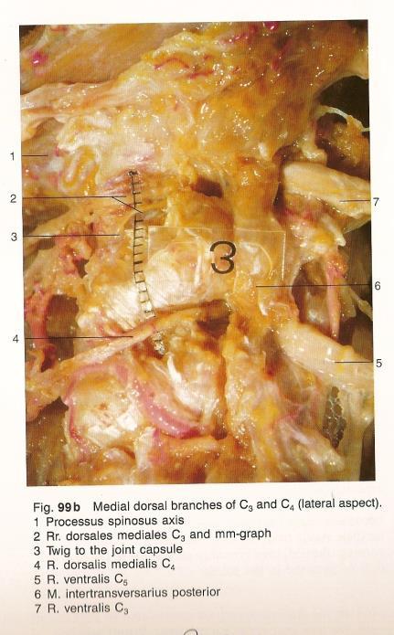 division medial branch becomes the 3rd occipital nerve (TON) and innervates C2-3 z-joint TON