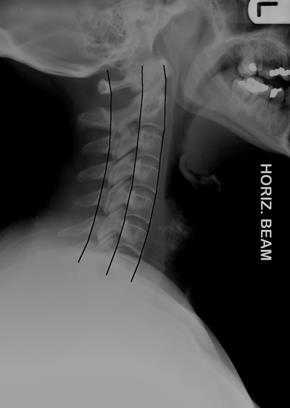 Diagnostic Cervical Medial Branch Block Lateral approach, patient lies on their side with painful side upwards.