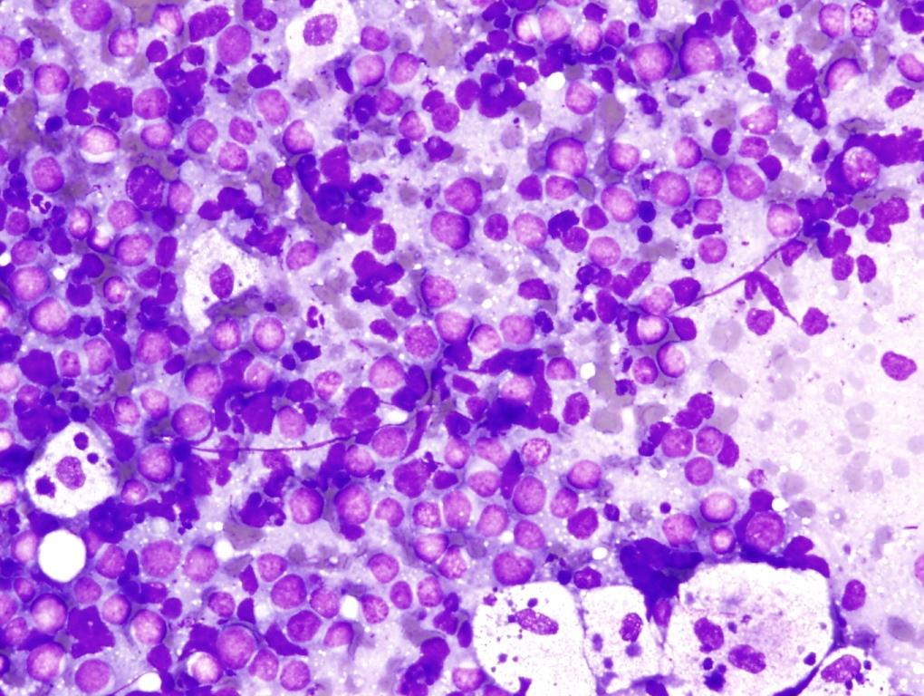 Diffuse Large B-cell