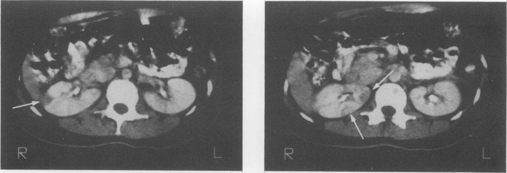 Figure 7 Contrast enhanced CT images of the kidneys showing poorly enhanced