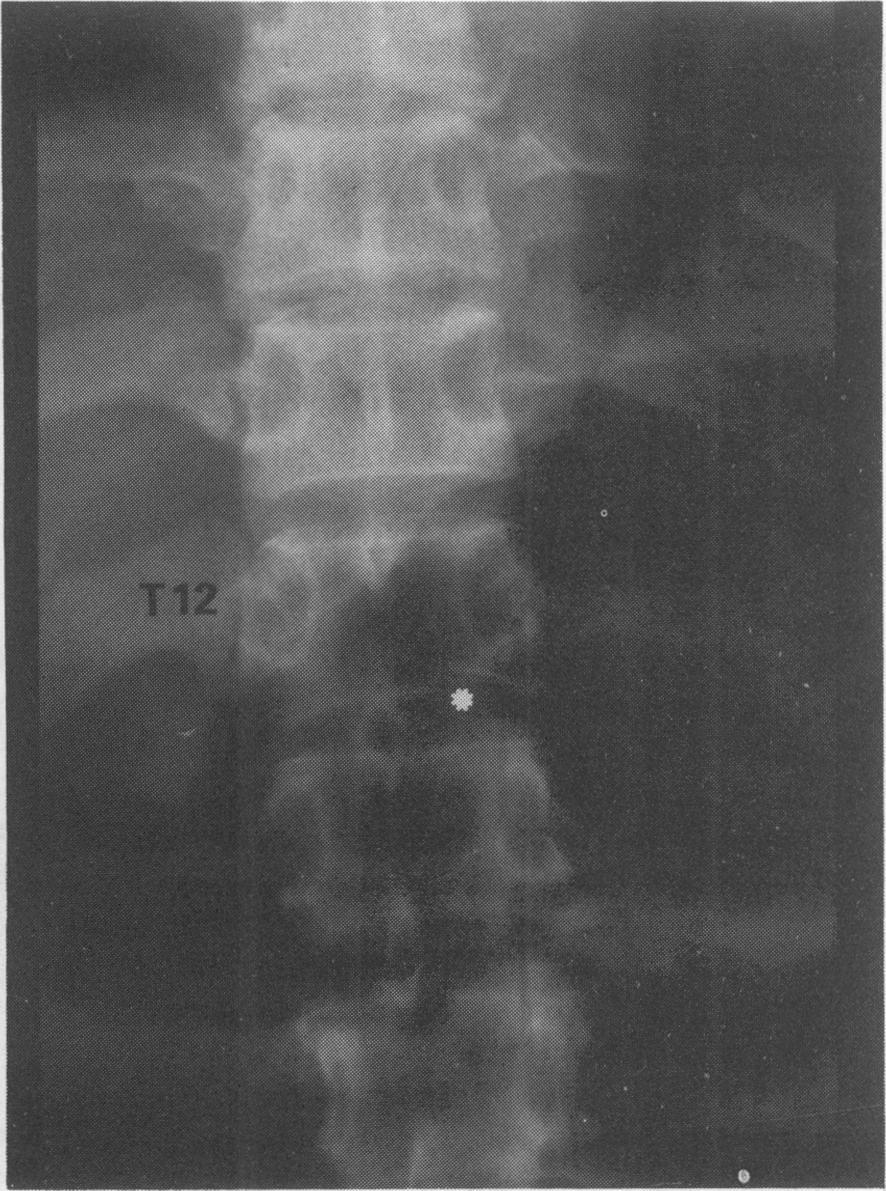 Figure 10 Thoraco-lumbar radiograph shows early compression of the inferior margin of the body of T12 as indicated.