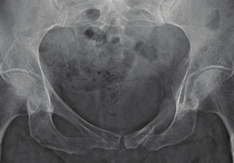 10 The Scientific World Journal B Figure 13: Insufficiency fracture. A 40-year-old male with a pelvic insufficiency fracture.