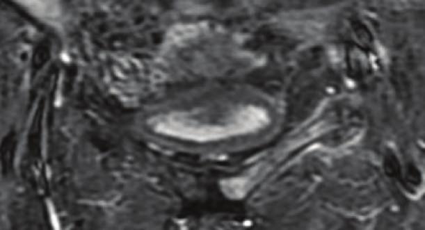 Coronal STIR of the pelvis demonstrates bone marrow edema throughout the left superior pubic ramus, fracture site, and surrounding callus (arrow). B: bladder.