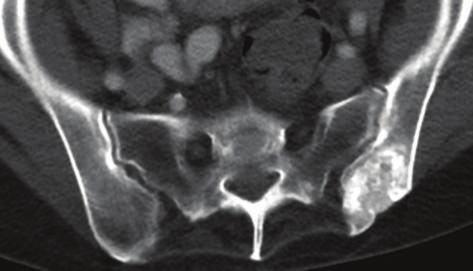 The anatomic location of this abnormality in the posterior iliac crest is very characteristic, and looking for evidence of back surgery on scout images helps with the diagnosis.