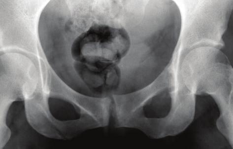 The Scientific World Journal 3 SP SP (d) (e) Figure 2: Osteolytic osteosarcoma.