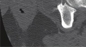 The extent of this predominantly lytic lesion with pockets of dense osteoid matrix is better