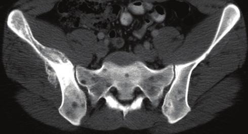 fluid-sensitive tumor tissue. Appreciating asymmetry between the two halves of the bony pelvis on plain films helps in identifying subtle lesions.
