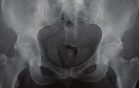 Axial post-contrast CT of the pelvis demonstrates a large destructive expansile necrotic mass (asterisk), arising within the right ilium and extending into the right sacrum.