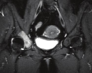 These lytic lesions can be difficult to identify on plain films and (d) more easily appreciated on coronal STIR and sagittal T1 (e) MRI.