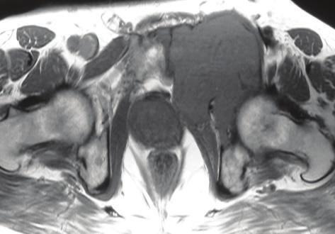 A thin mineralized periphery in keeping with expanded cortex is appreciated on CT (arrow).