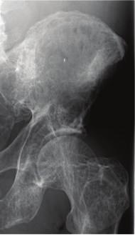 As expected in a chondrosarcoma, an ill-defined border and wide zone of transition is indicative of