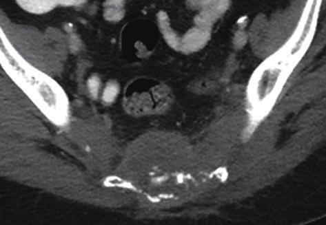 8 The Scientific World Journal P Figure 9: Chordoma. A 64-year-old female presenting with low back pain, diagnosed with an advanced sacral chordoma.
