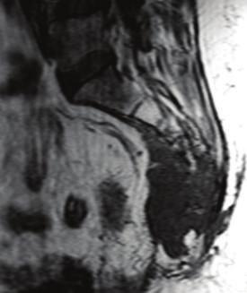 space posteriorly. Axial CT showing a large soft tissue metastasis (arrowheads) in the thigh around the femur.