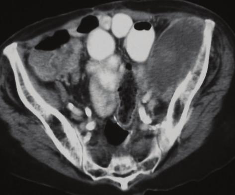 The Scientific World Journal 9 B Figure 10: Post-radiation sarcoma. A 78-year-old female presenting with left upper thigh and hip pain.