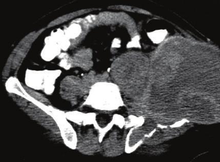 The clinical concern was the possibility of local tumor recurrence in the pubic symphysis region. The patient was subsequently diagnosed as having osteomyelitis.