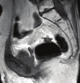 Biopsy and culture proved the changes were due to osteomyelitis, rather than tumor recurrence.