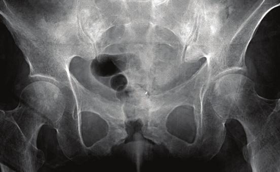 Gas is projected within the symphysis pubis and adjacent soft tissues in keeping with the known vesicovaginal fistula. Figure 11: Hemophilic pseudo tumor.