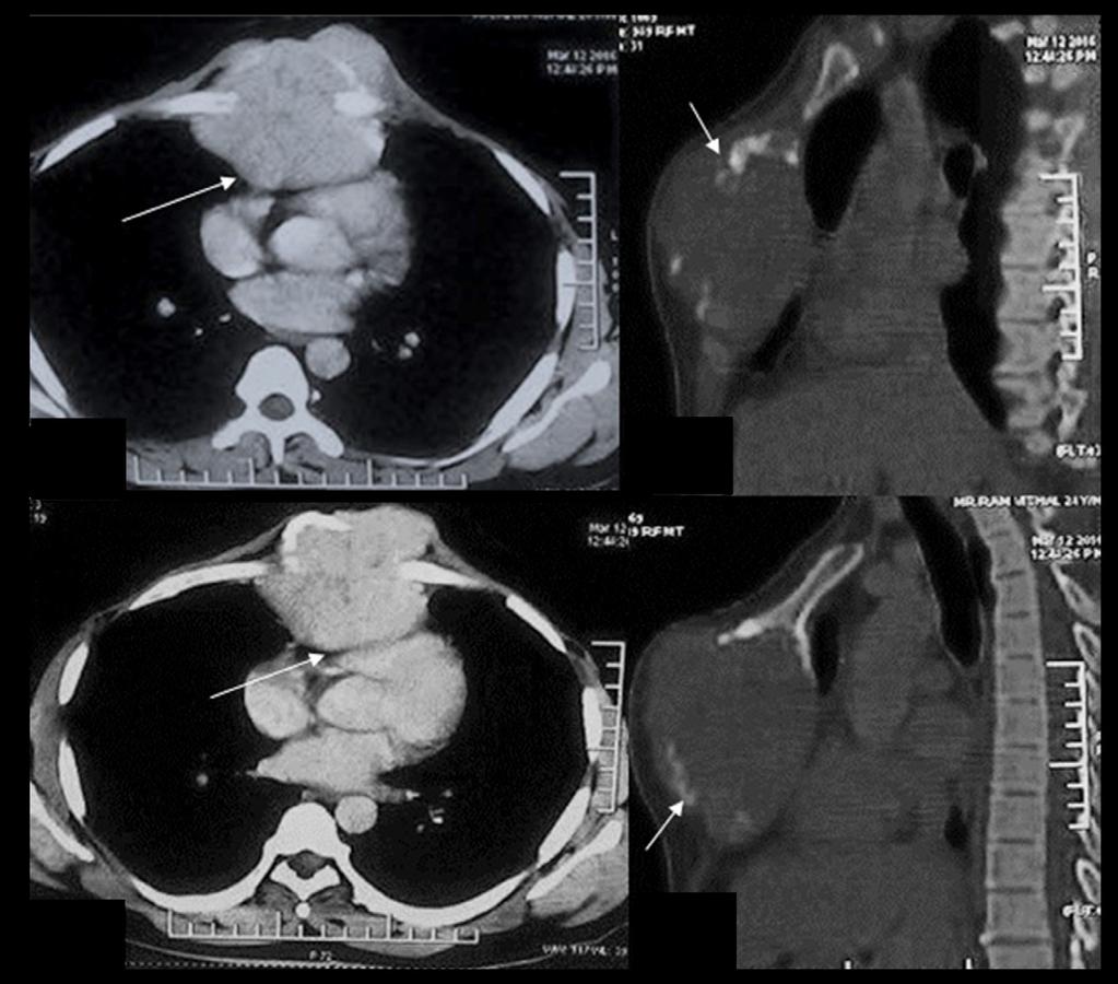 Review rticle D Figure 1. hondrosarcoma: 55-year-old male with a midline chest swelling.