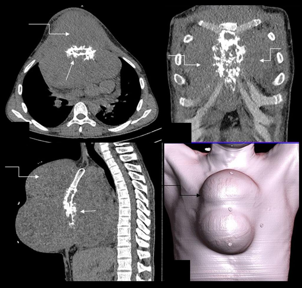 Review rticle D Figure 3. ( D) Ewing s sarcoma: 15-year-old male with a rapidly developing midline swelling and constitutional symptoms.