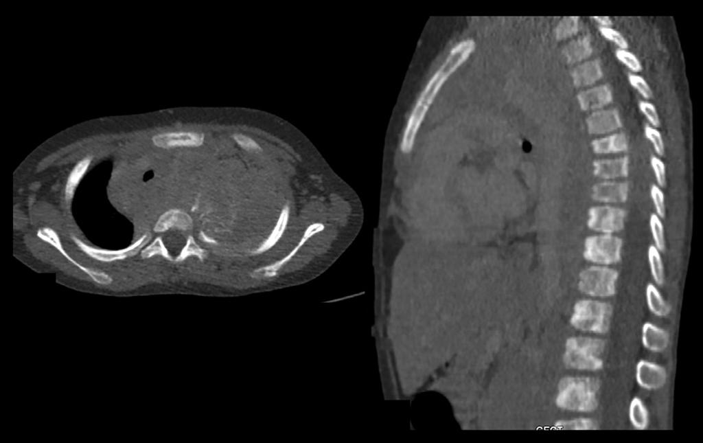 Review rticle Figure 7. (, ) Neuroblastoma metastases: Left-sided thoracic neuroblastoma in a 5-year-old child.