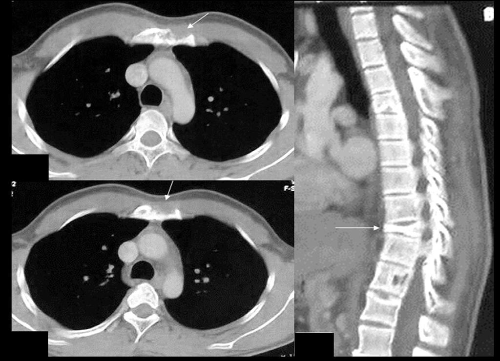LH (, ): n 8-year-old male with a lytic lesion (arrow) in the sternum causing cortical breach with scant soft tissue