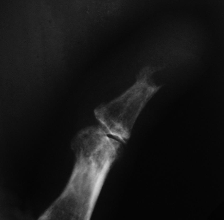 Defined Lytic Lesion (Glomus Tumor, Patient 5) Figure 5.
