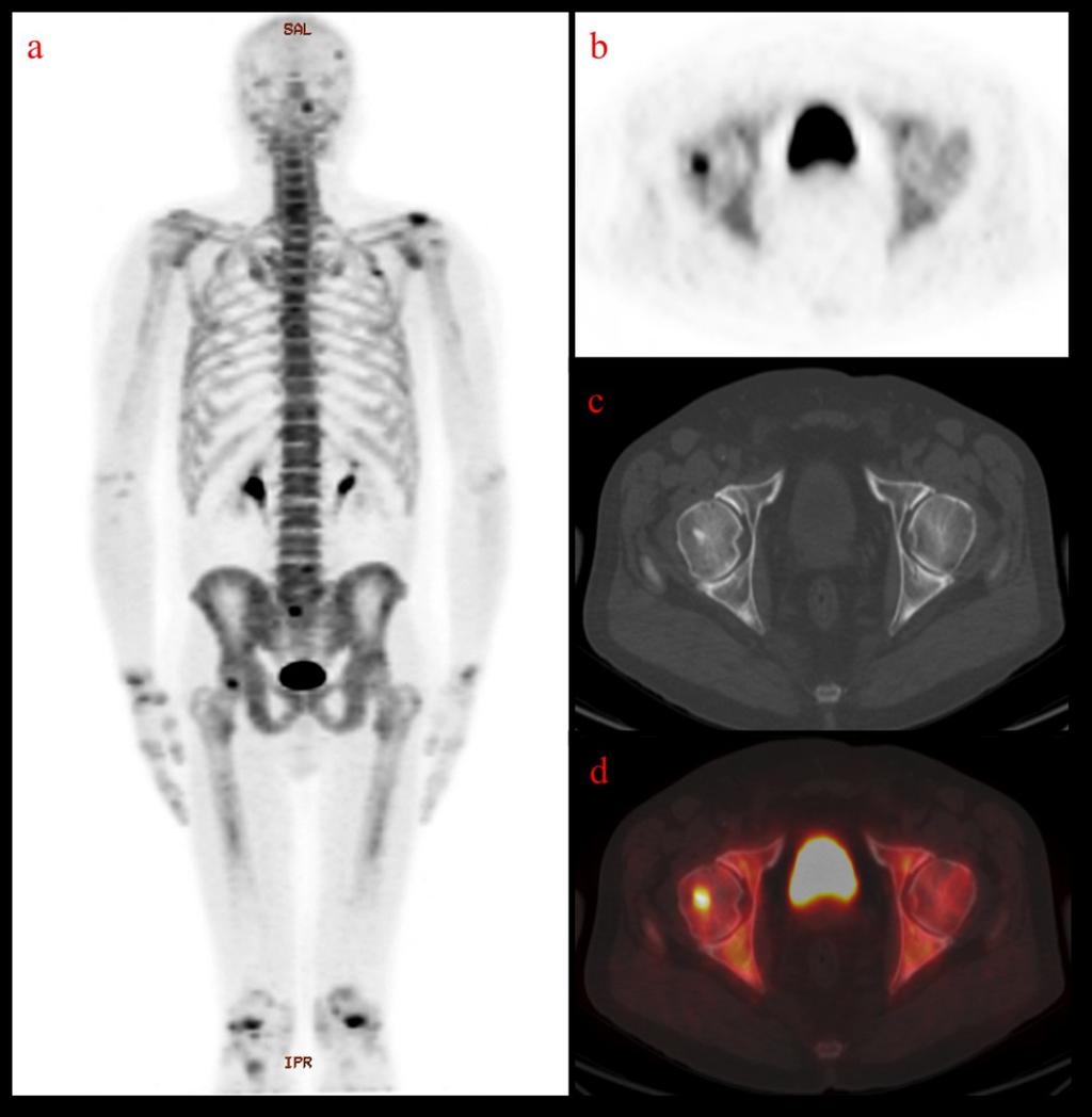 Fig. 10: F-18 NaF PET/CT MIP image demonstrating multiple foci of increased radiotracer uptake (a) and axial PET (b), axial noncontrast CT (c) and axial fused images (d) demonstrating a F-18 NaF-avid