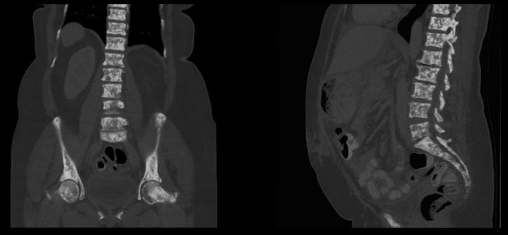 Fig. 3: Coronal and sagittal noncontrast CT demonstrating diffuse