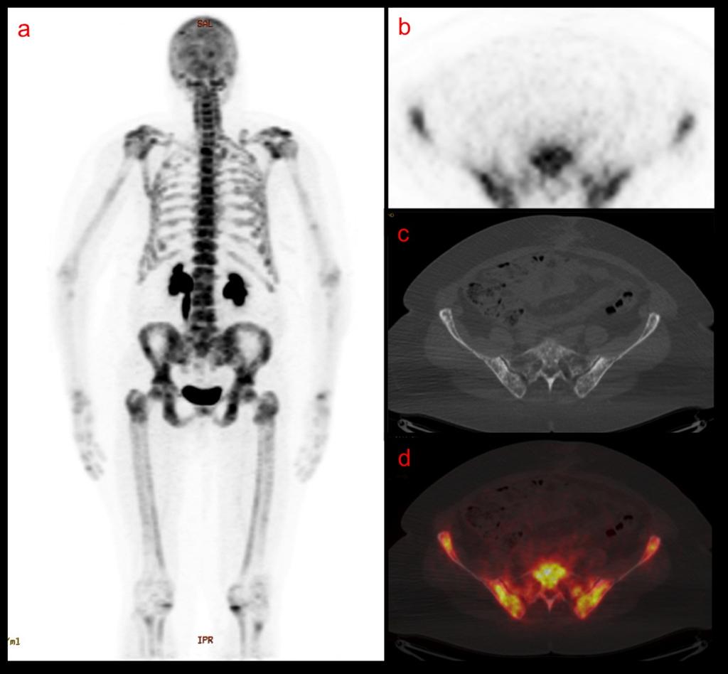 Fig. 5: F-18 NaF PET/CT MIP image demonstrating diffusely increased radiotracer uptake throughout the axial and appendicular skeleton (a) and axial PET (b), axial noncontrast CT (c) and axial fused