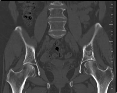 K, 75 yo Hip pain => Standard Xrays & ct scan Kystic lesion & fracture