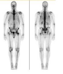 Imaging: scintigraphy